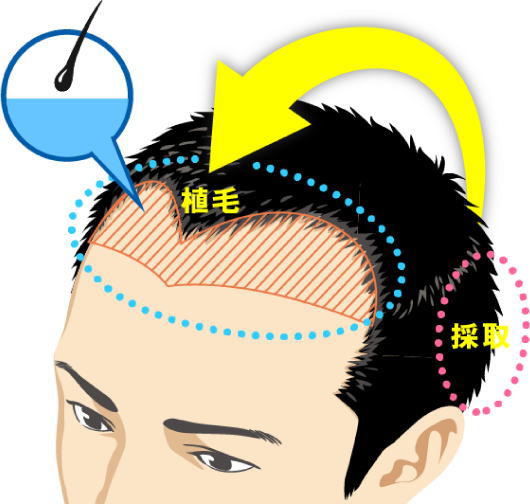 自毛植毛で後頭部は２つ施術方法がある！後頭部を刈り上げない施術法とは！